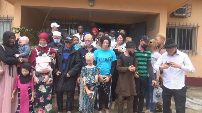Guinée :  Un pas de franchi dans la protection des personnes atteintes d'albinisme